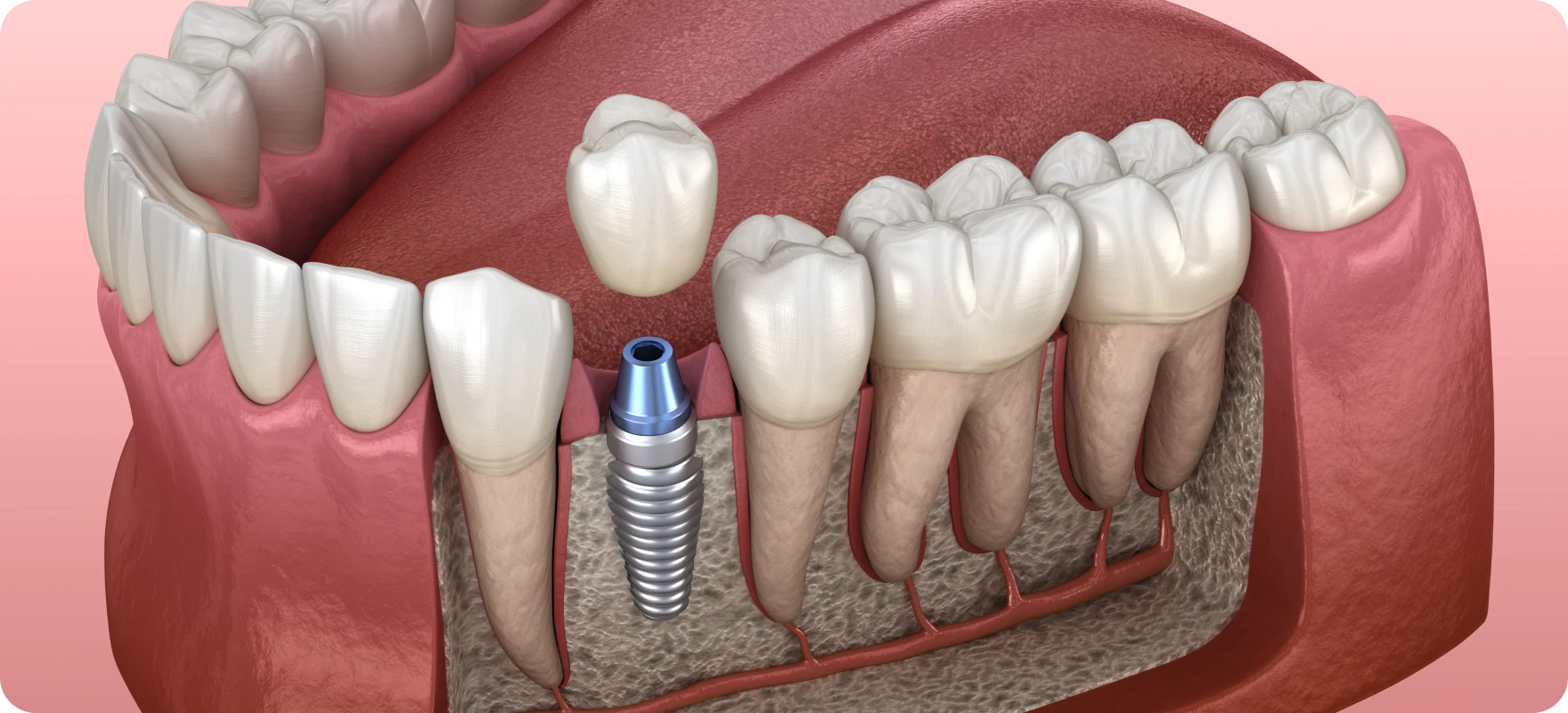 Implant dentaire unitaire